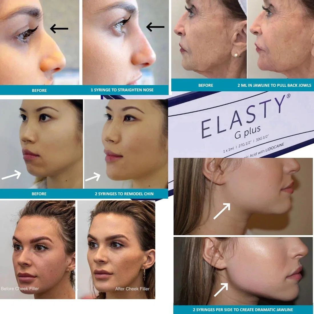 Korean Original Elasty Cross-Linked Hyaluronic Acid Dermal Filler