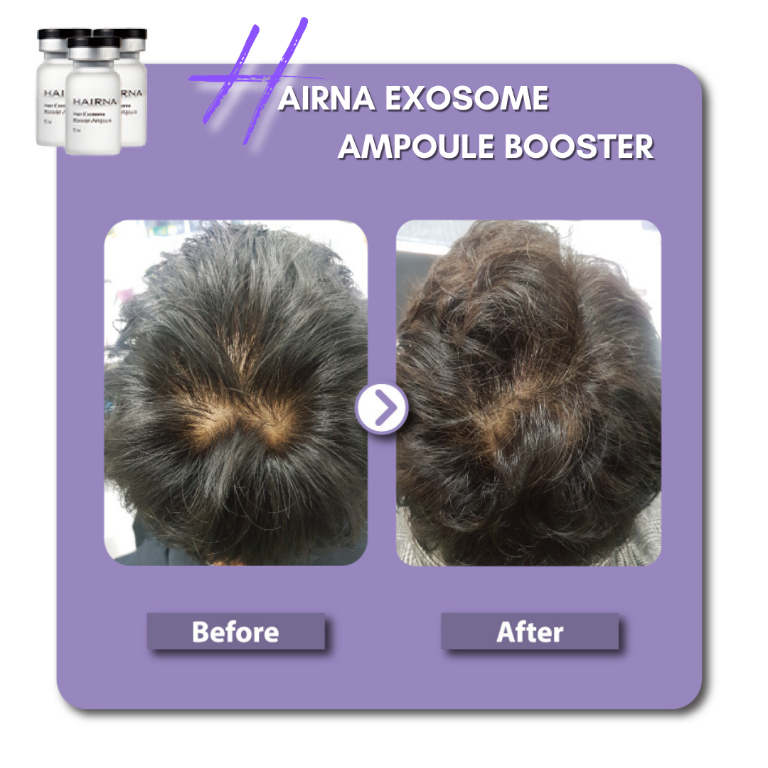 Hairna Hair Exosome Booster Ampoule Anti-Hair Loos Ampoule Technology of Separating and Refining Pure Exosomes 5ml*5