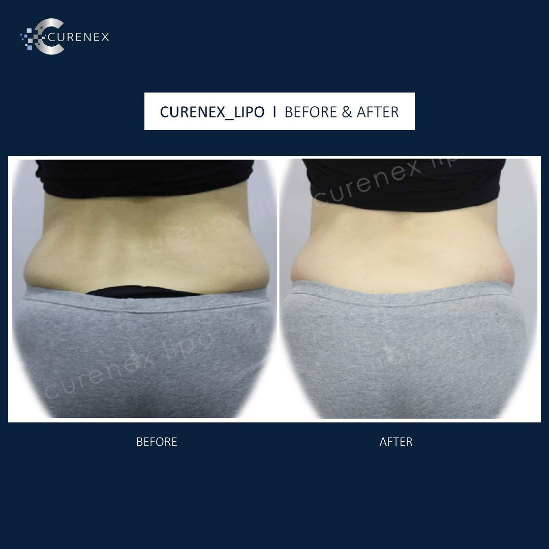 Curenex Lipo 10 Ml for Face and Body Lose Fat Losing Weight