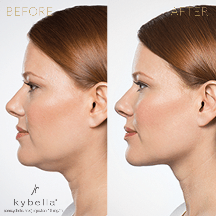 Kybella Dissolve Fat Double Chin Kybella Before and After Pictures DC Injection Weight Loss Kabelline Lipolab The Red