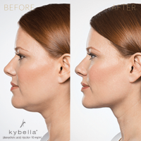 Kybella Dissolve Fat Double Chin Kybella Before and After Pictures DC Injection Weight Loss Kabelline Lipolab The Red