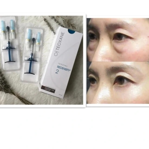 Teosyal Redensity 2 Puresense (2X1ml) Teoxane Under Eye Circle Fighter Filler Dermal Filler Hyaluronic Acid