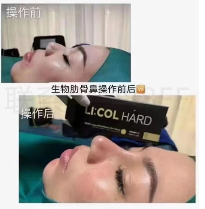 New Nose Filler Licol Hard Gold Nose Lifting Injection Korea Brand Dextran