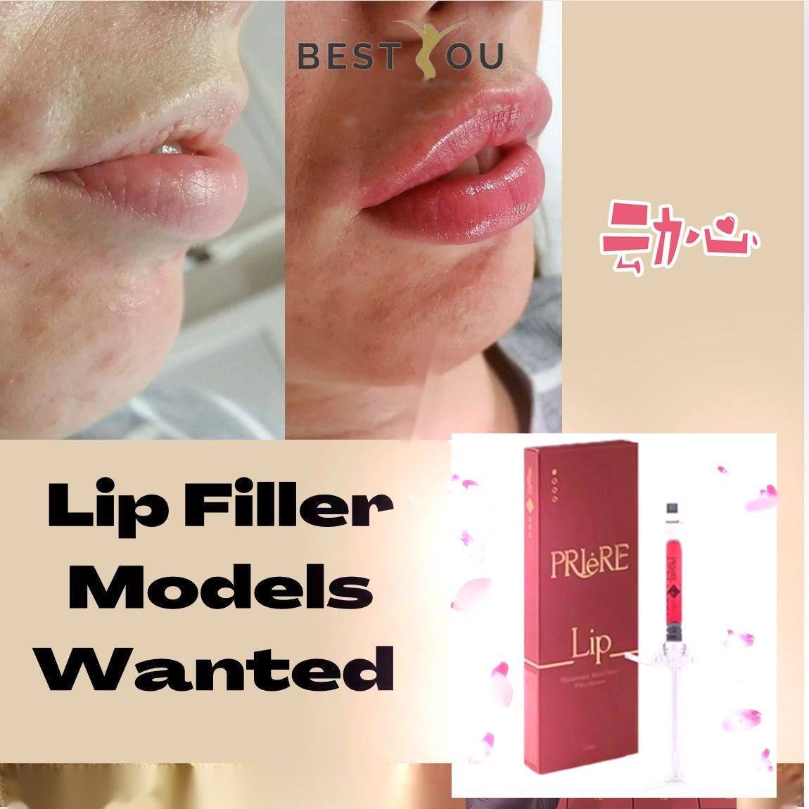 Priere Lip Fillers Nourish Hyaluronic Acid Dermal Filler Ha Filler Contains Vitamins for Lips Enhancement