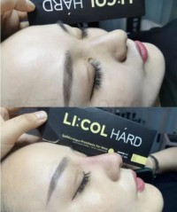 Dermal Filler Injection Licol Hard Nose Nasal Base Decree Lines Puppet Lines