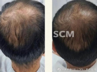 Scm Haircare Booster Hair Growth Products Stem Cell Growth Factors Anti Hair Loss Treatment Human Hairna Exosome Dr. Cy