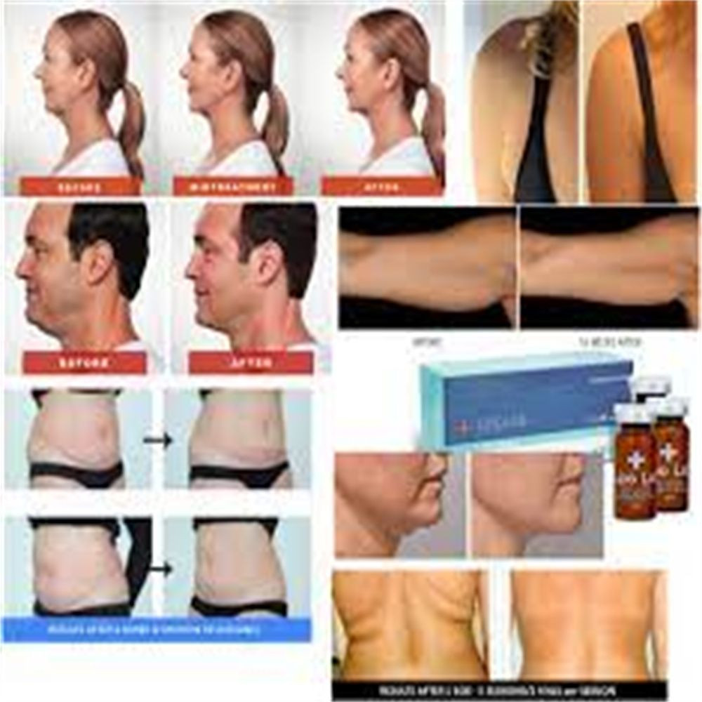 Korea Lipo Lab Slimming Solution Fat Dissolving Lipolysis Injection for Liquid Lipolab Melting Fat