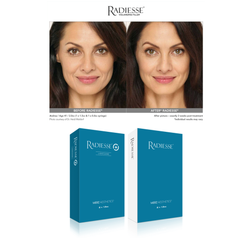 radiesse filler with Lidocaine (1x1.5ml)