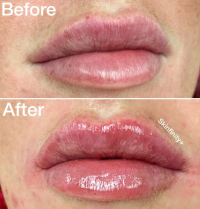 Revolax Dermal Filler Injection 1.1ml Lip Fullness to Remove Facial Wrinkles 1.1ml Dermal Filler for Lip