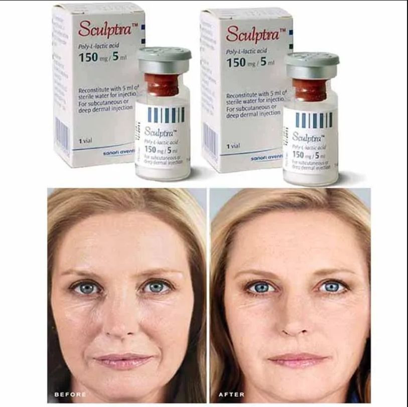 sculptra Original Anti-Aging PLA Plla Aesthefill 200mg New Generation Facial Wrinkle Filler Plla