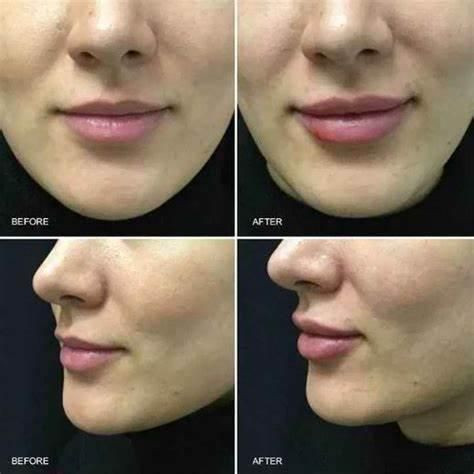 Wholesale Price Korean Injectable Spring Vom Lip and Nose Dermal Fillers