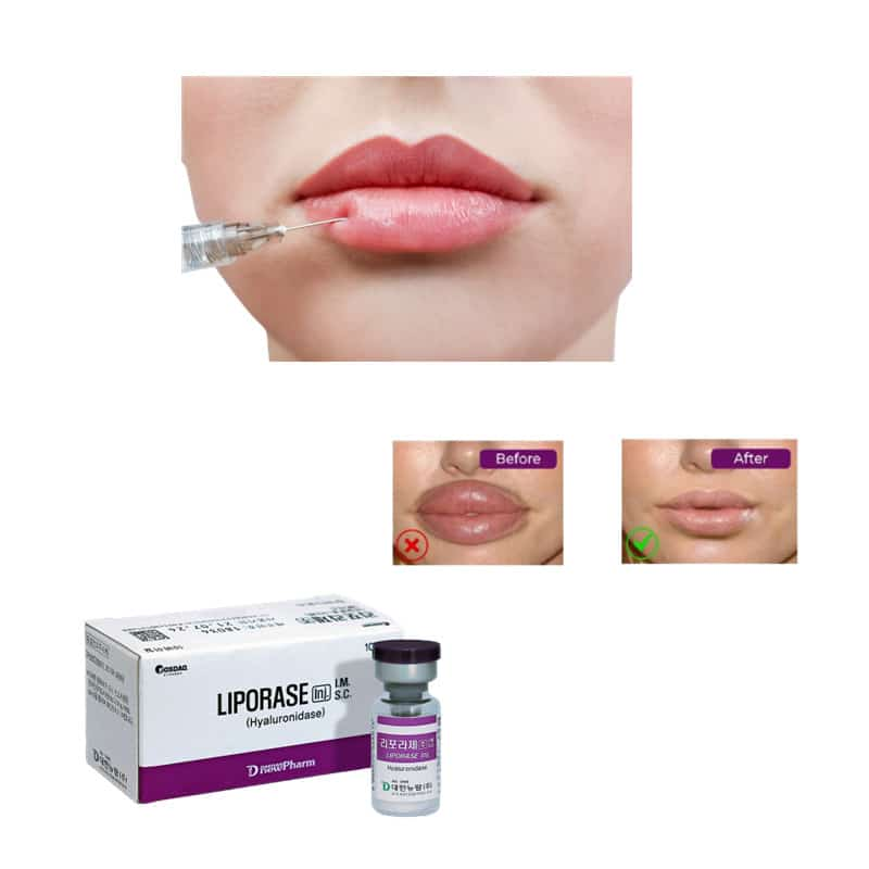 Liporase Dissolve Hyaluronic Acid Hyaluronidase Dissolves Hyaluronic Acid Liporase Hyaluronidase Liporase Injection Lip