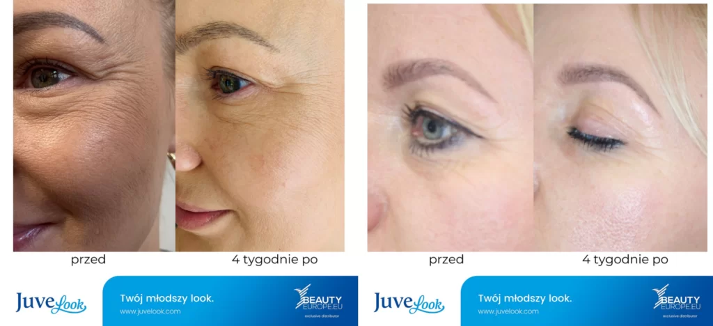 Juvelook Plla Ha Hybrid Filler CE Mark Elastic Rejuvenation Booster Regeneration Repair Produce More Collagen Juvelook