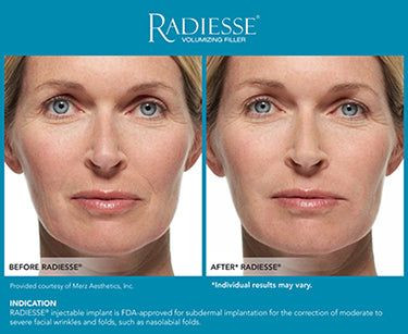 Hot Selling Radiesse Hyaluronic Acid Injection Skin Booster Reduce Nasolabial Folds Radiesse Plus Anti Aging Facial Wri